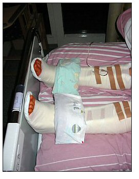 Stefanies Fueße in Gips