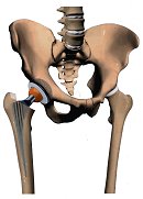 Hüftprothese