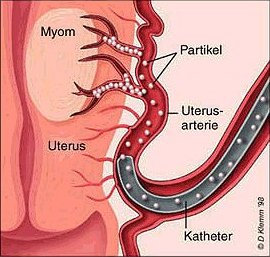 Embolisation