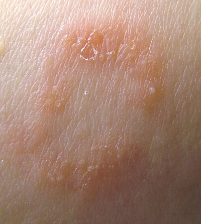 Trichophyton auf menschlicher Haut